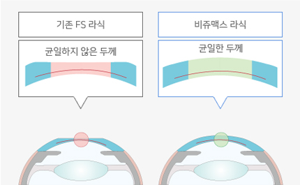 기존FS라식의 균일하지 않은 두께, 비쥬맥스 라식의 균일한 두께 비교 이미지