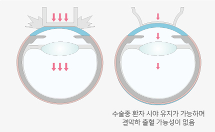 수술 중 환자 시야 유지가 가능하며 결막하 출혈 가능성이 없음