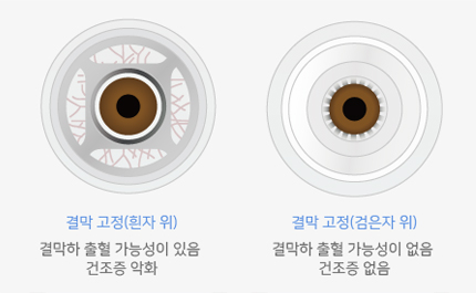 결막고정(흰자위) 결막하 출혈 가능성이 있음, 건조증 악화 - 결막고정(검은자위) 결막하 출혈 가능성이 없음, 건조증 없음 비교 이미지 