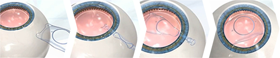 아쿠아ICL렌즈 수술과정 이미지